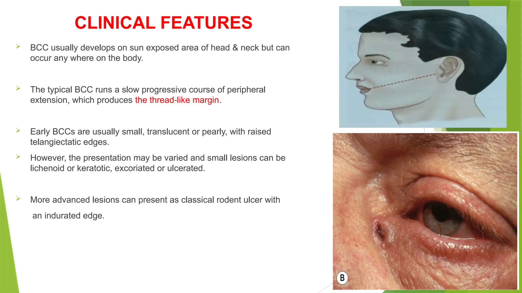CLINICAL FEATURES
 BCC usually develops on sun exposed area of head & neck but can
occur any where on the body.
 The typical BCC runs a slow progressive course of peripheral
extension, which produces the thread like margin
‐ .
 Early BCCs are usually small, translucent or pearly, with raised
telangiectatic edges.
 However, the presentation may be varied and small lesions can be
lichenoid or keratotic, excoriated or ulcerated.
 More advanced lesions can present as classical rodent ulcer with
an indurated edge.
 
