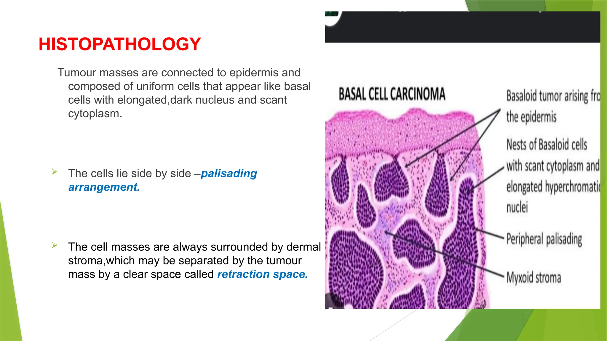 HISTOPATHOLOGY
Tumour masses are connected to epidermis and
composed of uniform cells that appear like basal
cells with elongated,dark nucleus and scant
cytoplasm.
 The cells lie side by side –palisading
arrangement.
 The cell masses are always surrounded by dermal
stroma,which may be separated by the tumour
mass by a clear space called retraction space.
 