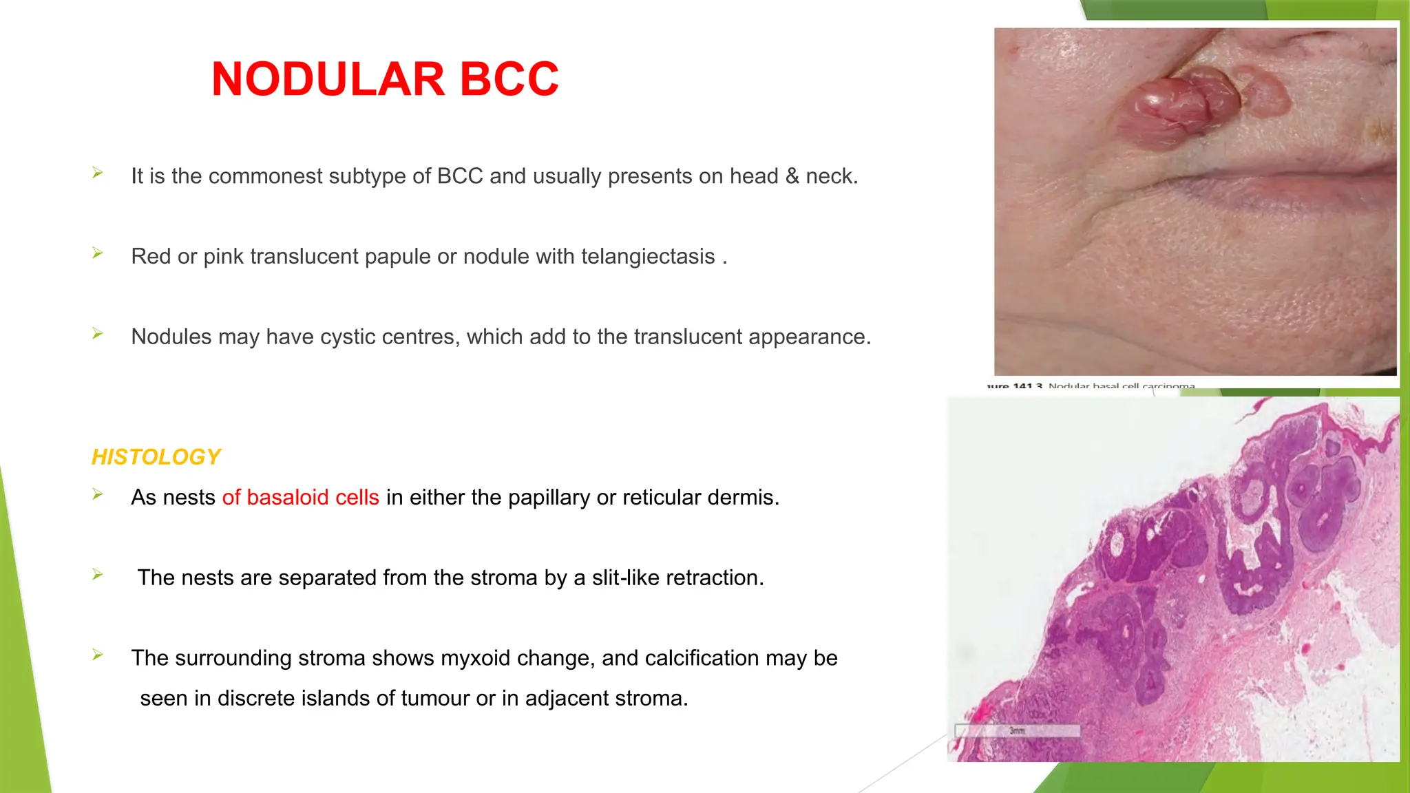 NODULAR BCC
 It is the commonest subtype of BCC and usually presents on head & neck.
 Red or pink translucent papule or nodule with telangiectasis .
 Nodules may have cystic centres, which add to the translucent appearance.
HISTOLOGY
 As nests of basaloid cells in either the papillary or reticular dermis.
 The nests are separated from the stroma by a slit like retraction.
‐
 The surrounding stroma shows myxoid change, and calcification may be
seen in discrete islands of tumour or in adjacent stroma.
 