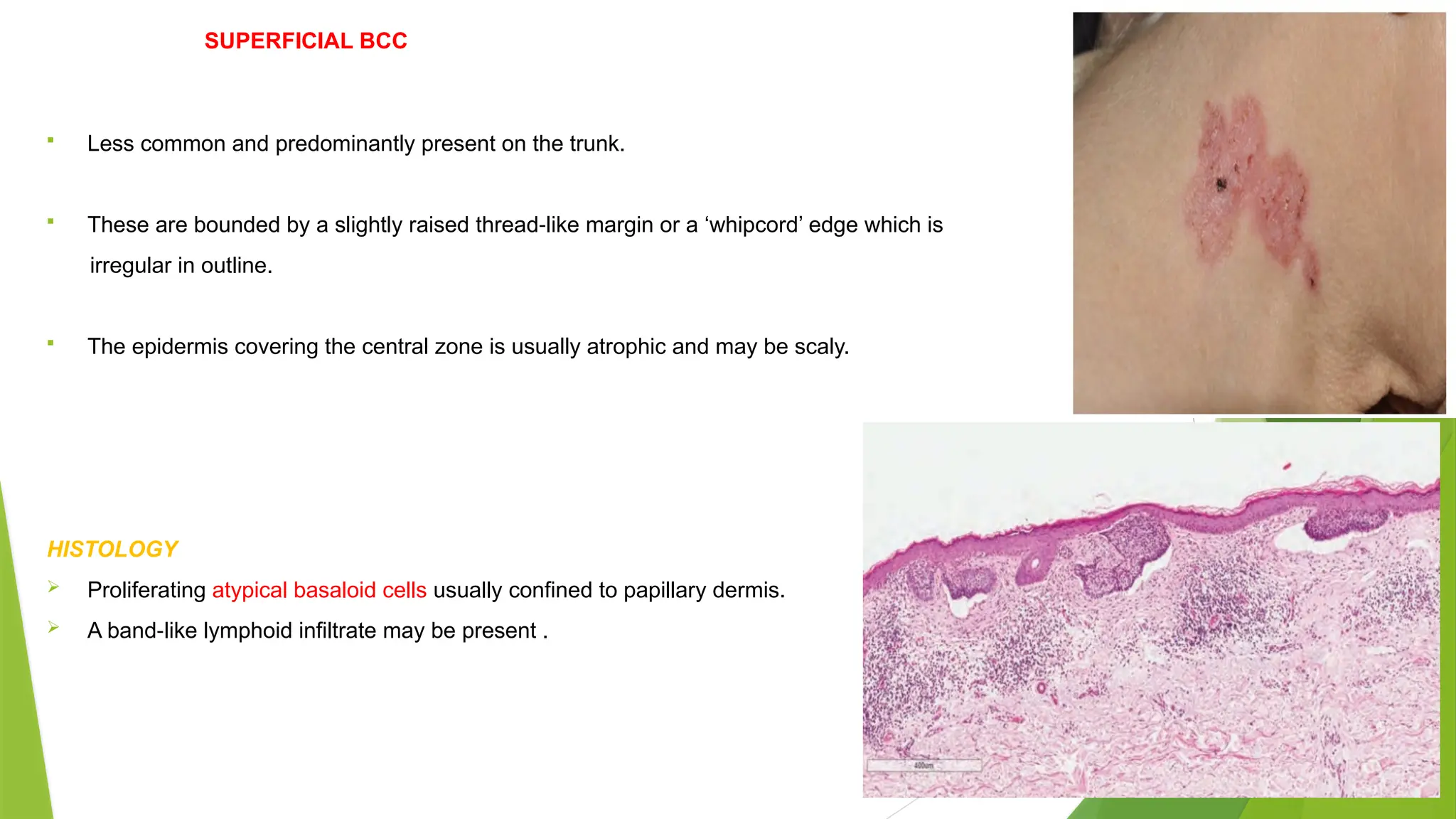 SUPERFICIAL BCC
 Less common and predominantly present on the trunk.
 These are bounded by a slightly raised thread like margin or a ‘whipcord’ edge which is
‐
irregular in outline.
 The epidermis covering the central zone is usually atrophic and may be scaly.
HISTOLOGY
 Proliferating atypical basaloid cells usually confined to papillary dermis.
 A band like lymphoid infiltrate may be present .
‐
 
