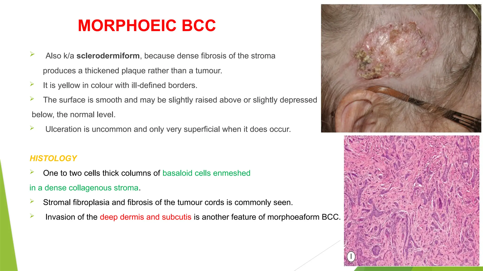 MORPHOEIC BCC
 Also k/a sclerodermiform, because dense fibrosis of the stroma
produces a thickened plaque rather than a tumour.
 It is yellow in colour with ill defined borders.
‐
 The surface is smooth and may be slightly raised above or slightly depressed
below, the normal level.
 Ulceration is uncommon and only very superficial when it does occur.
HISTOLOGY
 One to two cells thick columns of basaloid cells enmeshed
in a dense collagenous stroma.
 Stromal fibroplasia and fibrosis of the tumour cords is commonly seen.
 Invasion of the deep dermis and subcutis is another feature of morphoeaform BCC.
 