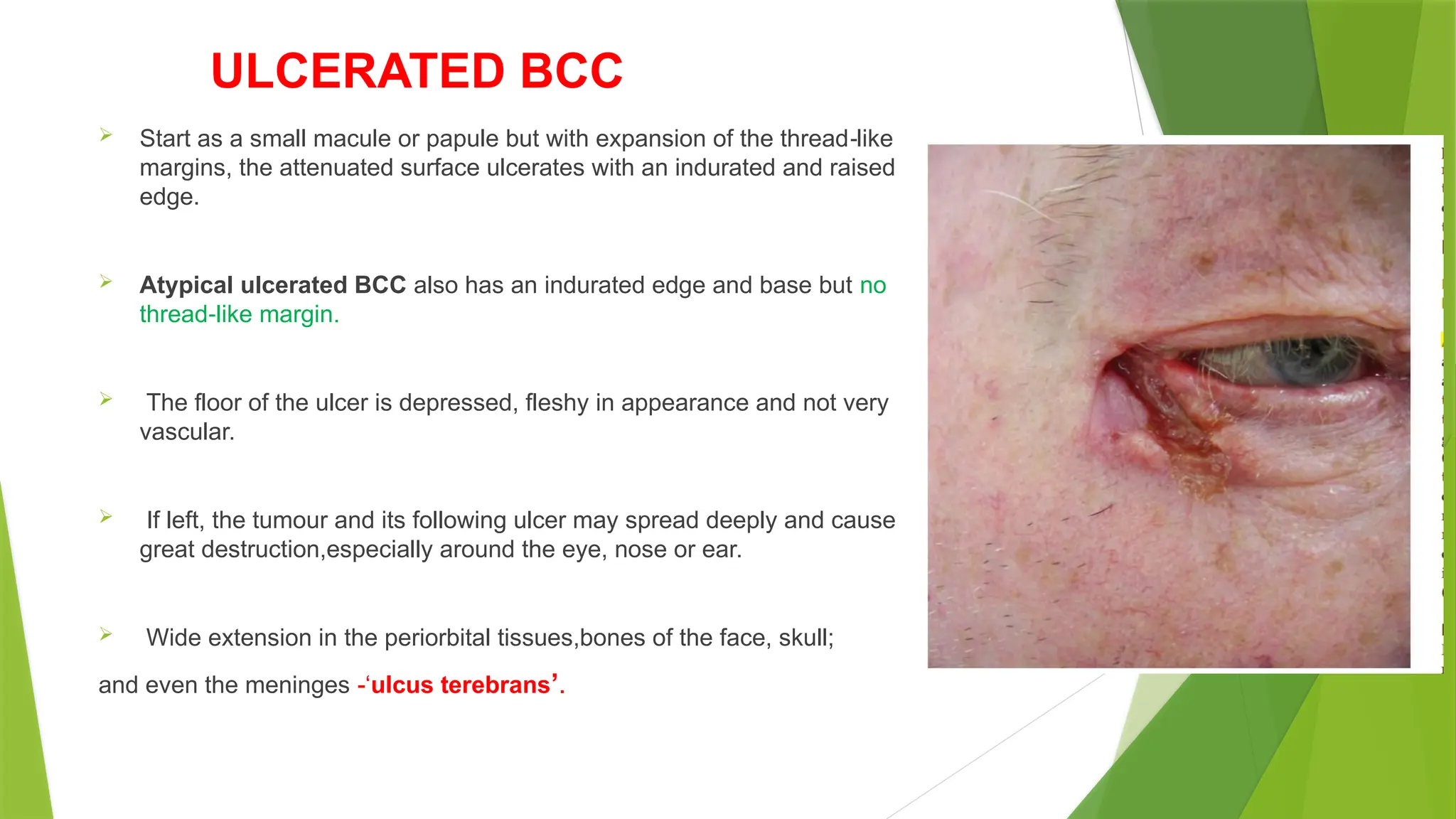 ULCERATED BCC
 Start as a small macule or papule but with expansion of the thread like
‐
margins, the attenuated surface ulcerates with an indurated and raised
edge.
 Atypical ulcerated BCC also has an indurated edge and base but no
thread like margin.
‐
 The floor of the ulcer is depressed, fleshy in appearance and not very
vascular.
 If left, the tumour and its following ulcer may spread deeply and cause
great destruction,especially around the eye, nose or ear.
 Wide extension in the periorbital tissues,bones of the face, skull;
and even the meninges -‘ulcus terebrans’.
 