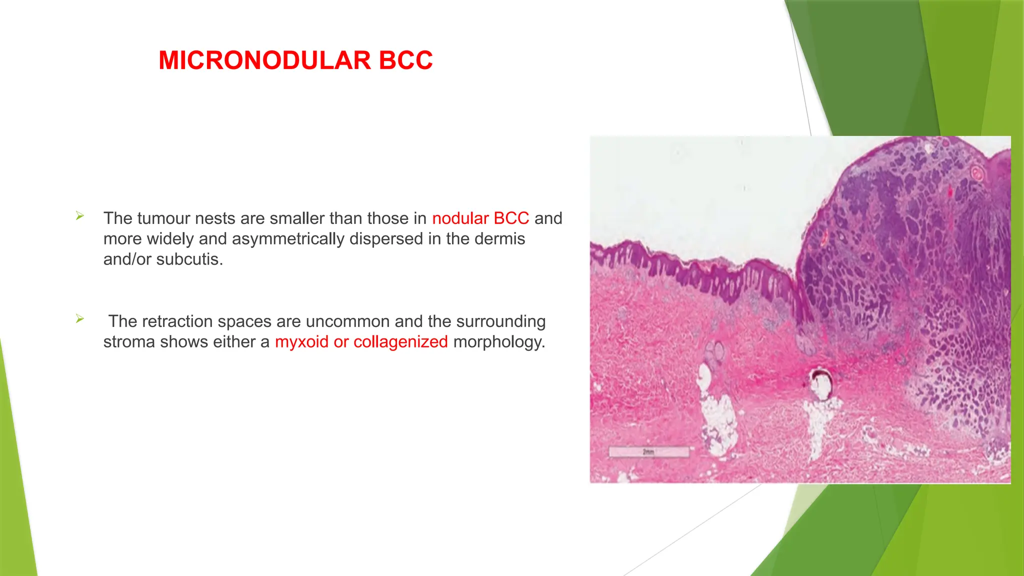 MICRONODULAR BCC
 The tumour nests are smaller than those in nodular BCC and
more widely and asymmetrically dispersed in the dermis
and/or subcutis.
 The retraction spaces are uncommon and the surrounding
stroma shows either a myxoid or collagenized morphology.
 