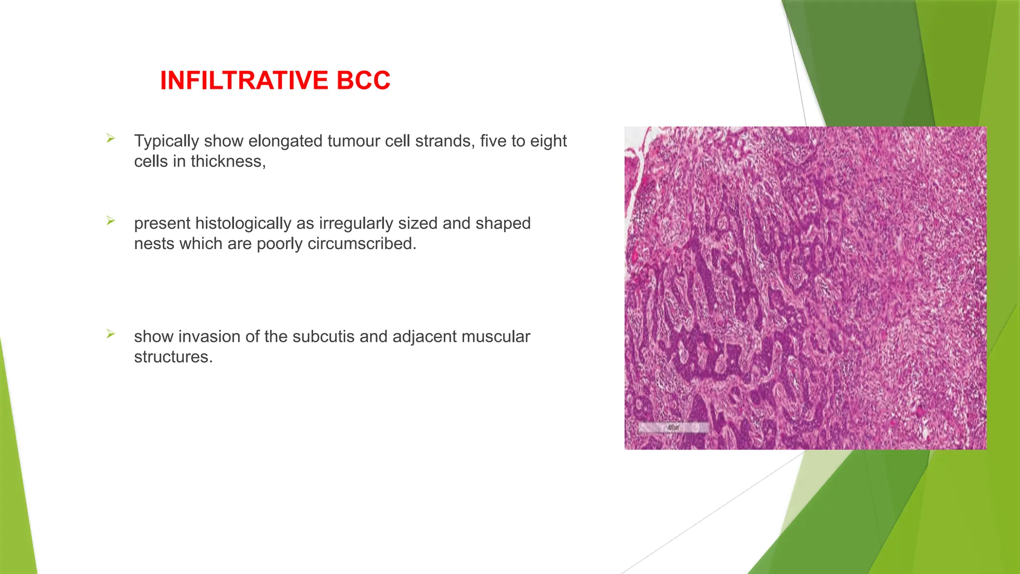 INFILTRATIVE BCC
 Typically show elongated tumour cell strands, five to eight
cells in thickness,
 present histologically as irregularly sized and shaped
nests which are poorly circumscribed.
 show invasion of the subcutis and adjacent muscular
structures.
 