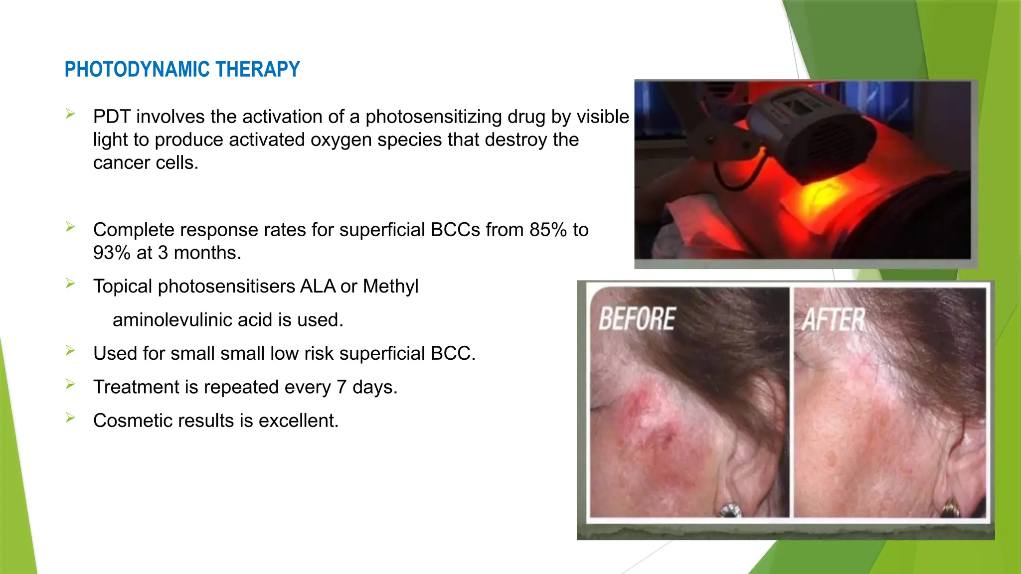 PHOTODYNAMIC THERAPY
 PDT involves the activation of a photosensitizing drug by visible
light to produce activated oxygen species that destroy the
cancer cells.
 Complete response rates for superficial BCCs from 85% to
93% at 3 months.
 Topical photosensitisers ALA or Methyl
aminolevulinic acid is used.
 Used for small small low risk superficial BCC.
 Treatment is repeated every 7 days.
 Cosmetic results is excellent.
 