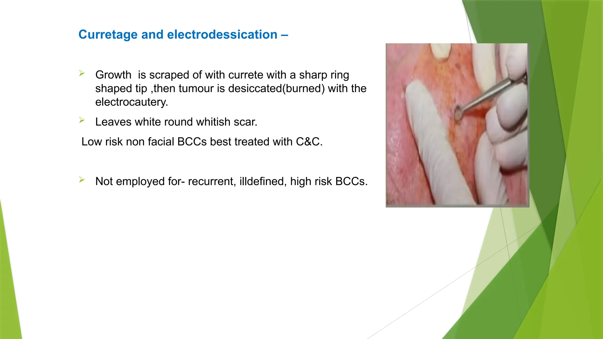 Curretage and electrodessication –
 Growth is scraped of with currete with a sharp ring
shaped tip ,then tumour is desiccated(burned) with the
electrocautery.
 Leaves white round whitish scar.
Low risk non facial BCCs best treated with C&C.
 Not employed for- recurrent, illdefined, high risk BCCs.
 