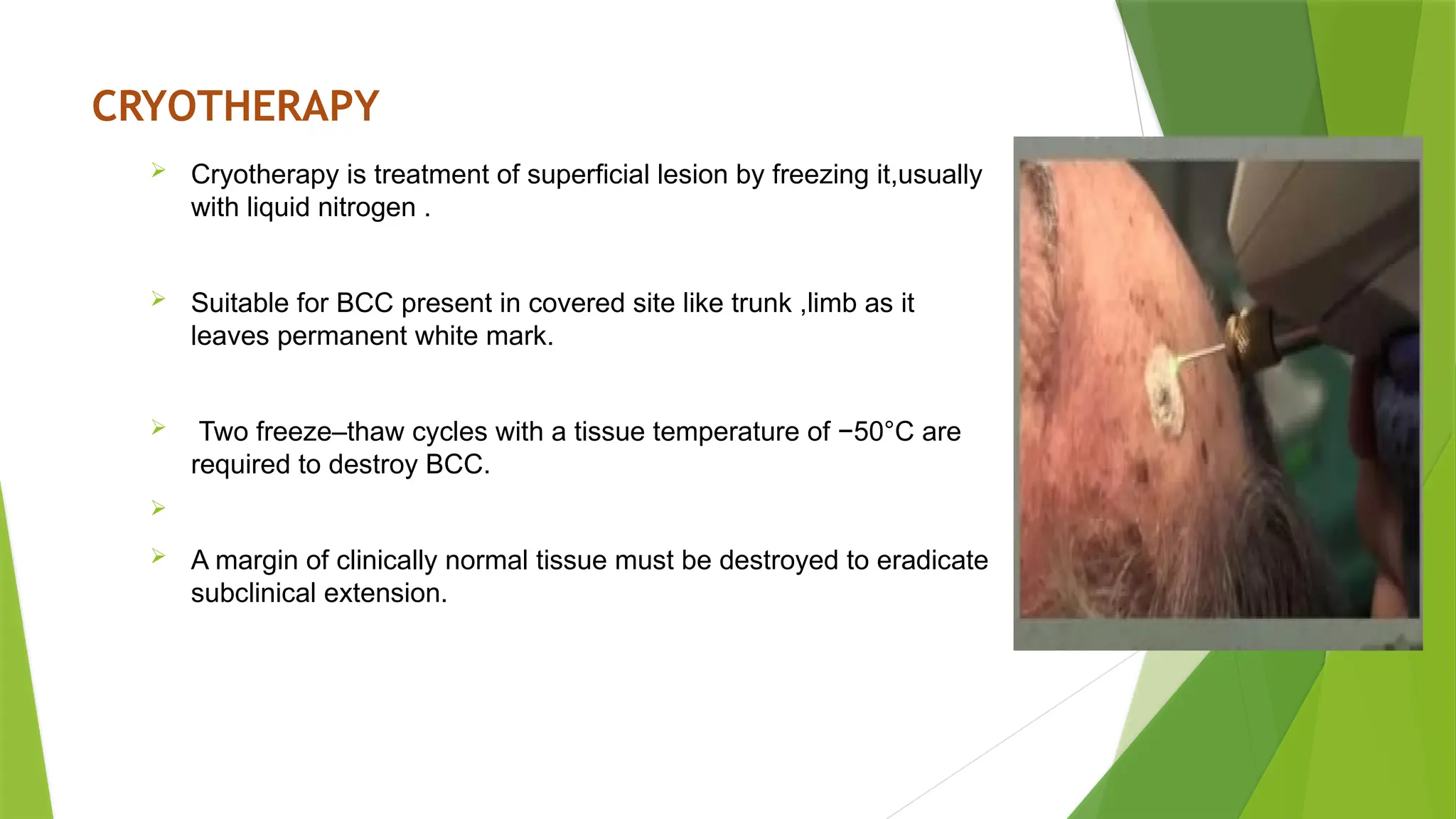 CRYOTHERAPY
 Cryotherapy is treatment of superficial lesion by freezing it,usually
with liquid nitrogen .
 Suitable for BCC present in covered site like trunk ,limb as it
leaves permanent white mark.
 Two freeze–thaw cycles with a tissue temperature of −50°C are
required to destroy BCC.

 A margin of clinically normal tissue must be destroyed to eradicate
subclinical extension.
 