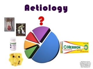 ?
Aetiology
http://herron.com.au
http://giantmicrobes.com
http://onlinepillspro.com
http://en.wikipedia.org
http://indyprops.com
 