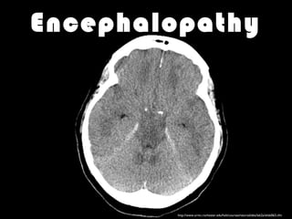 Encephalopathy
http://www.urmc.rochester.edu/hslt/courses/neuroslides/lab2a/slide063.cfm
 