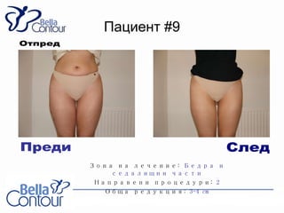 Пациент  #9 Зона на лечение :  Бедра и седалищни части Направени процедури :  2 Обща редукция :  3-4 cm След Преди Отпред 