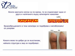 Когато мастните клетки са по-малки, те се отдалечават една от
             друга и налягането върху капилярите намалява




Кръвообръщението в тези капиляри се подобрява и метаболизмът
се ускорява




Кожата може по-добре да се възстанови,
нейната структура и вид се подобряват.
 