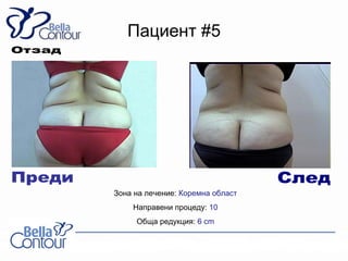 Пациент #5




Зона на лечение: Коремна област
    Направени процеду: 10
     Обща редукция: 6 cm
 