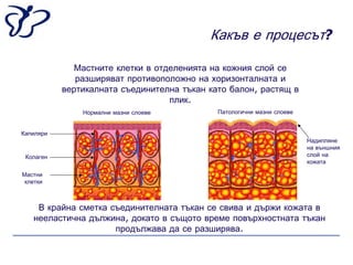 Какъв е процесът?

              Мастните клетки в отделенията на кожния слой се
              разширяват противоположно на хоризонталната и
           вертикалната съединителна тъкан като балон, растящ в
                                   плик.
               Нормални мазни слоеве         Патологични мазни слоеве


Капиляри
                                                                        Надипляне
                                                                        на външния
 Колаген                                                                слой на
                                                                        кожата

Мастни
 клетки



    В крайна сметка съединителната тъкан се свива и държи кожата в
   нееластична дължина, докато в същото време повърхностната тъкан
                     продължава да се разширява.
 