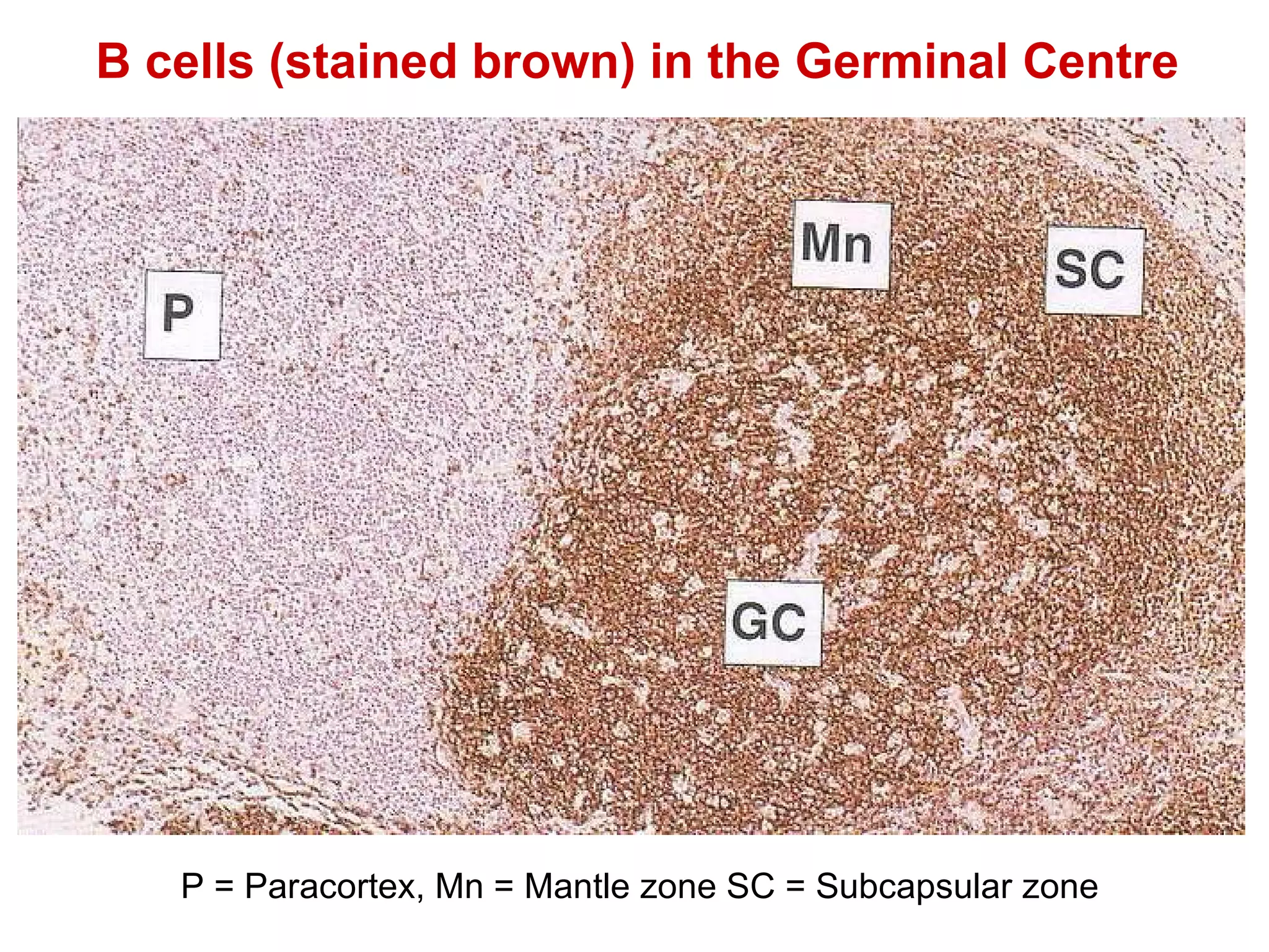 B cells (stained brown) in the Germinal Centre P = Paracortex, Mn = Mantle zone SC = Subcapsular zone 