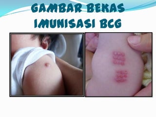 GAMBAR BEKAS
IMUNISASI BCG
 