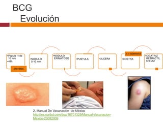 BCG
     Evolución


                                                                          2- 4 SEMANAS
•Papula < de                  •NODULO                                                    •CICATRIZ
 10 mm         •NODULO         ERIMATOSO     •PUSTULA       •ULCERA     •COSTRA           RETRACTIL
•48h            5-10 mm                                                                   6-9 MM


     ERITEMA




                 2. Manual De Vacunación de México
                 http://es.scribd.com/doc/16701329/Manual-Vacunacion-
                 Mexico-20082009
 