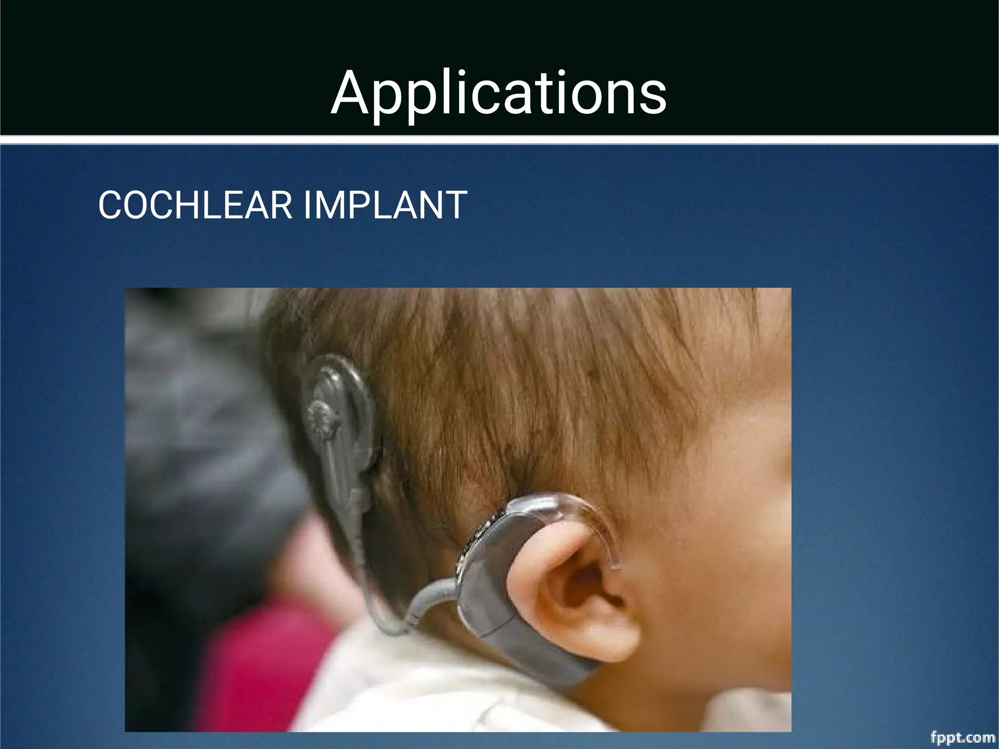 Applications
COCHLEAR IMPLANT
 