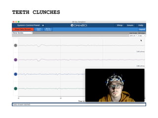 TEETH CLUNCHES
https://youtu.be/cKnRIrj6vGc
 