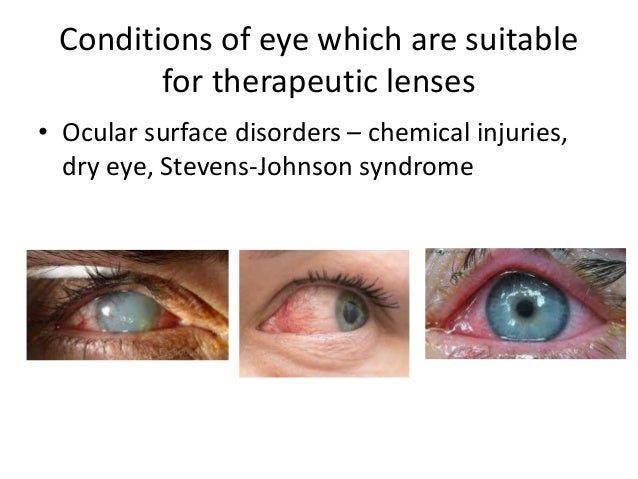 Bandage Contact Lens