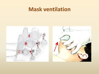 Mask ventilation
 