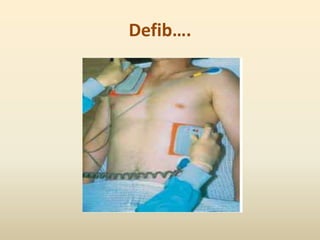 Defib….
 