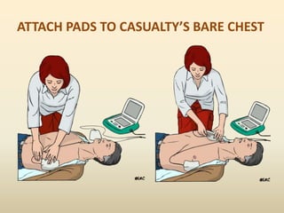 ATTACH PADS TO CASUALTY’S BARE CHEST
 