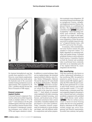 BC MEDICAL JOURNAL VOL. 52 NO. 9, NOVEMBER 2010 www.bcmj.org458
for titanium hemispherical cups has
recently been reported at over 95%.9
However, wear-related complications
of the polyethylene liner inside and on
the backside (and of the associated
modular locking mechanism) occur in
approximately 20% of patients by 20
years, a problem that has become the
focus of research in THR surgery.
Femoral component
implant fixation
Cemented femoral component fixa-
tion has achieved excellent long-term
results in multiple studies at 17 to 30
years10-14 and continues to be the gold
standard against which the more pop-
ular cementless femoral fixation must
be measured. Contemporary cement-
ing techniques were refined in the
1970s and require attention to detail.
In addition to cement technique, there
are two implant designs: the cemented
tapered polished collarless stem (Ex-
eter, Stryker Orthopaedics, Mahwah
NJ) and the Spectron EF stem (Smith
& Nephew Orthopaedics, Memphis
TN) ( ) which have incorpo-
rated differing design characteristics,
yet which have both proven very
successful in the long-term clinical
trials.15,16 Early failures of cemented
stems implanted with older cementing
technique included loosening, stem
fracture, and localized areas of bone
destruction (osteolysis) from cement
weardebris.Cementlessimplantswere
developed to solve these problems.
Today, cementless femoral compo-
nents are produced in various designs
and shapes, and with different metal-
lic compositions and surface prepara-
Figure 3
tion to promote osseo-integration. All
uncementedfemoralstemdesignsrely
on metaphyseal fixation, metaphy-
seal-diaphyseal junction fixation, dia-
physeal fixation, or a combination of
the three. The tapered titanium alloy
cementless stem ( ) has grown
in popularity17 and is becoming com-
monly used worldwide. Achieving
a press-fit via a single or dual taper-
ed wedge with subsequent proximal
osseo-integration of bone has proven
successful in multiple long-term stud-
ies18 of tapered titanium stems, with
over 95% survival at 10 to 20 years.
In summary, while cemented fem-
oral stem fixation remains the gold
standard in long-term studies, it is
highly dependent on cementing tech-
nique and implant design. Cemented
acetabular fixation is rarely utilized in
North America. Cementless fixation
on both the femoral and acetabular
sides is performed most commonly
and relies on an immediate press-fit
of the implant followed by osseo-
integration into host bone.
Hip resurfacing
Total hip resurfacing, also known as
surface replacement arthroplasty or
hip resurfacing (HR), has gained in
popularity partly because of two
metal-on-metal HR implants approv-
ed by the FDAwithin the past 9 years.
HR has been performed for 15 years
in both North America and Europe
with favorable results.19,20 It is per-
formed using a cemented metal fem-
oral component shaped to the patient’s
native femoral head and a cementless
acetabular component with a polished
inner cobalt-chrome metal surface
( ). The two surfaces join to
create a metal-on-metal bearing
surface that has low-wear properties.
Relative indications for HR surgery21
include younger age, active occu-
pational and lifestyle requirements,
favorable bone anatomy and quality
Figure 5
Figure 4
Total hip arthroplasty: Techniques and results
Figure 3. Cemented femoral component. (A) Spectron EF component (Smith & Nephew,
Memphis, TN). (B) Postoperative radiograph showing cemented femoral stem combined with a
cementless acetabular component, cross-linked polyethylene modular liner, and cobalt-
chrome modular femoral head.
A B
 