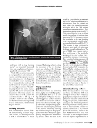 www.bcmj.org VOL. 52 NO. 9, NOVEMBER 2010 BC MEDICAL JOURNAL 461
and team, with a steep learning
curve27 and potentially increased
risks and complications when com-
pared with conventional THR.
While HR is an option to consider
in younger and more active patients, it
requires careful preoperative assess-
ment and a discussion with the patient
about all of the issues, including the
risk of increased metal ion levels and
metal sensitivity reactions, and the
low risk of psuedotumor.28 In addi-
tion, impact activities are not encour-
aged after HR, and the restrictions and
precautions following surgery are
similar to those for THR. Overall, the
short-term results of HR (up to 5
years) have been worse than for THR,
and therefore hip resurfacing should
be used with caution. THR remains
the gold standard.
Bearing surfaces
With current implant fixation meth-
ods demonstrating excellent long-
term results, the bearing surface
in THR is now the focus of much
research.The bearing surface is where
the movement of the two bearings
occurs and which provides the range
of motion and articulation of the pros-
thetic ball and socket joint. Within the
last 10 years, the use of traditional
ultrahigh molecular weight polyethyl-
ene (UHMWPE) acetabular liners has
declined with the development of new
kinds of polyethylene.
Highly cross-linked
polyethylenes
To reduce wear rates and particulate
debris, highly cross-linked polyethyl-
ene (XLPE) has been used in total
hip arthroplasty for 8 years. The man-
ufacturing process for these materials
cross-links the molecules and im-
proves wear characteristics but slight-
ly reduces the strength of the polyeth-
ylene. Free radicals may be generated
in the process, potentially allowing
for oxidative changes in the polyeth-
ylene, unless these changes are appro-
priately managed in the manufactur-
ing process. Thus, the ideal XLPE
would be cross-linked at an appropri-
ate level of radiation, and then remelt-
ed to remove these free radicals and
thus reduce the oxidation process.
Currently, all of the THR implant
manufacturers produce either a first-
generationorsecond-generationXLPE.
When combined with a polished
cobalt-chrome head of multiple sizes,
these new XLPEs have shown prom-
ise in reducing in vivo and simulator
wear measurements significantly29
comparedwithtraditionalUHMWPE.
The increase in wear resistance is,
however, associated with a decrease
in fatigue strength and toughness. The
use of XLPE liners requires meticu-
lous positioning of the acetabular
component to avoid vertical place-
ment of the implant, which reports
have associated with an increased risk
of fracture at the rim of the polyethyl-
ene liner ( ). The use of XLPE
has allowed the introduction of larger
femoral heads, which increase the sta-
bility of the hip with their greater dia-
meter and increased “jump distance.”
When XLPE is used, wear rates of the
polyethylene have not been shown to
be worse with larger femoral heads.
This is in contrast to older UHMWPE,
which demonstrates higher volumet-
ric polyethylene wear as the size of
the femoral head is increased.
Alternative bearing surfaces
Other bearing surfaces have been
developed and utilized in THR in an
attempt to reduce the wear-related
polyethylene complications. Polyeth-
ylene wear and debris formation result
in hip joint synovitis, joint instability,
osteolysis, and, potentially, prosthesis
loosening.Alternativebearingsurfaces
such as metal-on-metal, ceramic-on-
ceramic, ceramic-on-XLPE, oxinium
(oxidized zirconium), and even the
new XLPEs themselves have been
developed in an attempt to reduce
wear and improve implant survival in
Figure 8
Total hip arthroplasty: Techniques and results
Figure 7. Radiograph showing a femoral neck fracture that occurred at 4 months following
a left hip resurfacing procedure.
 