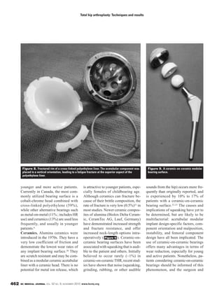 BC MEDICAL JOURNAL VOL. 52 NO. 9, NOVEMBER 2010 www.bcmj.org462
younger and more active patients.
Currently in Canada, the most com-
monly utilized bearing surface is a
cobalt-chrome head combined with
cross-linked polyethylene (59%),
while other alternative bearings such
as metal-on-metal (11% ; includes HR
use) and ceramics (13%) are used less
frequently, and usually in younger
patients.4
Ceramics. Alumina ceramics were
introduced in the 1970s. They have a
very low coefficient of friction and
demonstrate the lowest wear rates of
any implant bearing surface.30 They
are scratch resistant and may be com-
bined as a modular ceramic acetabular
liner with a ceramic head. There is no
potential for metal ion release, which
is attractive to younger patients, espe-
cially females of childbearing age.
Although ceramics can fracture be-
cause of their brittle composition, the
rate of fracture is very low (0.5%)31 in
most studies. Newer ceramic compos-
ites of alumina (Biolox Delta Ceram-
ic, CeramTec AG, Lauf, Germany)
have demonstrated increased strength
and fracture resistance, and offer
increased neck-length options intra-
operatively ( ). Ceramic-on-
ceramic bearing surfaces have been
associated with squeaking that is audi-
ble to the patient and others. Initially
believed to occur rarely (~1%) in
ceramic-on-ceramicTHR,recentstud-
ies have shown that noise (squeaking,
grinding, rubbing, or other audible
Figure 9
sounds from the hip) occurs more fre-
quently than originally reported, and
is experienced by 10% to 17% of
patients with a ceramic-on-ceramic
bearing surface.32,33 The causes and
implications of squeaking have yet to
be determined, but are likely to be
multifactorial: acetabular modular
implant design-specific factors, com-
ponent orientation and malposition,
instability, and femoral component
design have all been implicated. The
use of ceramic-on-ceramic bearings
offers many advantages in terms of
wear reduction, especially for young
and active patients. Nonetheless, pa-
tients considering ceramic-on-ceramic
bearings should be informed of this
phenomenon, and the surgeon and
Total hip arthroplasty: Techniques and results
Figure 8. Fractured rim of a cross-linked polyethylene liner. The acetabular component was
placed in a vertical orientation, leading to a fatigue fracture at the superior aspect of the
polyethylene liner.
Figure 9. A ceramic-on-ceramic modular
bearing surface.
 
