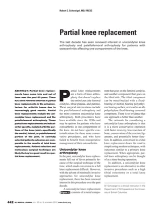 BC MEDICAL JOURNAL VOL. 52 NO. 9, NOVEMBER 2010 www.bcmj.org442
ABSTRACT: Partial knee replace-
ments have come into and out of
favor over the past 60 years. There
has been renewed interest in partial
knee replacements in the armamen-
tarium for arthritic knees due to
increasingly good results. Partial
knee replacements include the uni-
condylar knee replacement and the
patellofemoral arthroplasty. These
partial knee replacements are indicat-
ed for specific, isolated arthritic por-
tions of the knee joint—specifically
the medial, lateral, or patellofemoral
portion of the joint. In carefully
selected patients outcomes are com-
parable to the results of total knee
replacements. Patient selection and
meticulous surgical technique are
likely the key to a good result in a par-
tial knee replacement.
P
artial knee replacements
are a form of knee arthro-
plasty that doesn’t replace
the entire knee (the femoral
condyles, tibial plateau, and patella).
These surgical interventions include
the patellofemoral arthroplasty and
the more common unicondylar knee
arthroplasty. Both procedures have
been available since the 1950s and
may be options for patients who have
osteoarthritis in one compartment of
the knee, do not have specific con-
traindications for these more conser-
vative procedures, and who have
failed to benefit from nonoperative
management of their osteoarthritis.
Unicondylar knee
arthroplasty
In the past, unicondylar knee replace-
ments fell out of favor primarily be-
cause of the surgical technique of the
time, which made conversion to a full
knee replacement difficult. However,
with the advent of minimally invasive
approaches for unicondylar knee
replacement, there has been renewed
interest in this procedure over the past
decade.
A unicondylar knee replacement
( ) consists of a metal compo-Figure 1
nent that goes on the femoral condyle,
and another component that goes on
the tibial side. The tibial component
can be metal-backed with a fixed-
bearing or mobile-bearing polyethyl-
ene bearing surface, or it can be an all-
polyethylene fixed-bearing cemented
component. There is no evidence that
one approach is better than another.
The rationale for considering a
unicondylar knee arthroplasty is that
it is a more conservative operation
with faster recovery, less resection of
bone, conservation of the cruciate lig-
aments, and potentially better func-
tion. In addition, conversion to a total
knee replacement down the road is
simple using modern techniques, with
outcomes similar to a primary knee
replacement. When appropriate, par-
tial knee arthroplasty can be thought
of as a time-buying operation.
In addition, a unicondylar knee
replacement is an alternative to other
invasive procedures such as a high
tibial osteotomy or a total knee
replacement.
Partial knee replacement
The last decade has seen renewed interest in unicondylar knee
arthroplasty and patellafemoral arthroplasty for patients with
osteoarthritis affecting one compartment of the knee.
Robert C. Schweigel, MD, FRCSC
Dr Schweigel is a clinical instructor in the
Department of Orthopaedics at the Univer-
sity of British Columbia.
 
