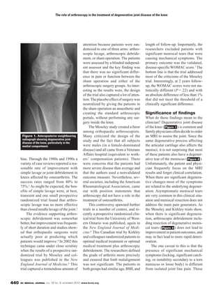 BC MEDICAL JOURNAL VOL. 52 NO. 9, NOVEMBER 2010 www.bcmj.org440
attention because patients were ran-
domized to one of three arms: arthro-
scopic lavage, arthroscopic debride-
ment, or sham operation. The patients
were assessed by a blinded independ-
ent assessor and the key finding was
that there was no significant differ-
ence in pain or function between the
sham operation and either of the
arthroscopic surgery groups. As inter-
esting as the results were, the design
of the trial also captured a lot of atten-
tion.Theplaceboeffectofsurgerywas
neutralized by giving the patients in
the sham operation an anaesthetic and
creating the standard arthroscopic
portals, without performing any sur-
gery inside the knee.
The Moseley study created a furor
among orthopaedic arthroscopists.
Many criticized the design of the
study and the fact that all subjects
were males (in a female-dominated
disease) and all came from a Veterans
Affairs hospital (equivalent to work-
ers’ compensation patients). There
were concerns that the patients had
more severe disease than average and
that the authors used a nonvalidated
outcome measure. Nevertheless, sev-
eral societies, including the American
Rheumatological Association, came
out with position statements that
arthroscopy did not have a role in the
treatment of osteoarthritis.
This controversy spawned further
trials in a number of centres, and re-
cently a prospective randomized clin-
ical trial from the University of West-
ern Ontario was published, again in
the New England Journal of Medi-
cine.6 This Canadian trial by Kirkley
and colleagues randomized patients to
optimal medical treatment or optimal
medical treatment plus arthroscopic
debridement. The researchers defined
the grade of arthritis more precisely
and ensured that limb malalignment
was not significant. The patients in
both groups had similar age, BMI, and
length of follow-up. Importantly, the
researchers excluded patients with
significant meniscal tears that were
causing mechanical symptoms. The
primary outcome was the validated,
disease-specificWOMAC score.7 The
bottom line is that the trial addressed
most of the criticisms of the Moseley
trial. Interestingly, at 2 years follow-
up, the WOMAC scores were not sta-
tistically different (P = .22) and with
an absolute difference of less than 1%
that did not meet the threshold of a
clinically significant difference.
Significance of findings
What do these findings mean to the
clinician? Degenerative joint disease
of the knee ( ) is common and
familyphysiciansoftendecidetoorder
an MRI to assess the joint. Since the
same degenerative process affecting
the articular cartilage also affects the
menisci, it is not surprising that most
of these patients also have a degener-
ative tear of the meniscus ( ).
Unfortunately, the patient and physi-
cian frequently focus on the MRI
results and forget clinical correlation.
When there are significant degenera-
tive changes most of the symptoms
are related to the underlying degener-
ation. Asymptomatic meniscal tears
are very common in this clinical situ-
ation and meniscal resection does not
address the main pain generators. As
the Moseley and Kirkley trials show,
when there is significant degenera-
tion, arthroscopic debridement inclu-
ding resection of degenerative menis-
cal tears ( ) does not lead to
improvementinpatientoutcomes,and
may in fact lead to more rapid deteri-
oration.
The one caveat to this is that the
presence of significant mechanical
symptoms (locking, significant catch-
ing, or instability secondary to a torn
meniscus or loose body) is different
from isolated joint line pain. These
Figure 3
Figure 2
Figure 1
The role of arthroscopy in the treatment of degenerative joint disease of the knee
bias. Through the 1980s and 1990s a
variety of case reviews reported a rea-
sonable rate of improvement with
simple lavage or joint debridement in
knees affected by osteoarthritis. The
success rates ranged from 40% to
75%.2 As might be expected, the ben-
efits of simple lavage were, at best,
transient and one small prospective
randomized trial found that arthro-
scopic lavage was no more effective
than closed needle lavage of the joint.3
The evidence supporting arthro-
scopic debridement was somewhat
better, but improvement was frequent-
ly of short duration and studies show-
ed that orthopaedic surgeons were
actually poor at predicting which
patients would improve.4 In 2002 this
technique came under close scrutiny
when the results of a prospective ran-
domized trial by Moseley and col-
leagues was published in the New
England Journal of Medicine.5 This
trial captured a tremendous amount of
Figure 1. Anteroposterior weightbearing
radiograph showing degenerative joint
disease of the knee, particularly in the
medial compartment.
 