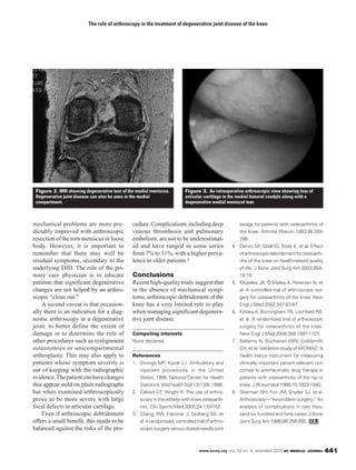 www.bcmj.org VOL. 52 NO. 9, NOVEMBER 2010 BC MEDICAL JOURNAL 441
mechanical problems are more pre-
dictably improved with arthroscopic
resection of the torn meniscus or loose
body. However, it is important to
remember that there may well be
residual symptoms, secondary to the
underlying DJD. The role of the pri-
mary care physician is to educate
patients that significant degenerative
changes are not helped by an arthro-
scopic “clean out.”
A second caveat is that occasion-
ally there is an indication for a diag-
nostic arthroscopy in a degenerative
joint, to better define the extent of
damage or to determine the role of
other procedures such as realignment
osteotomies or unicompartmental
arthroplasty. This may also apply to
patients whose symptom severity is
out of keeping with the radiographic
evidence.Thepatientcanhavechanges
that appear mild on plain radiographs
but when examined arthroscopically
prove to be more severe with large
focal defects in articular cartilage.
Even if arthroscopic debridement
offers a small benefit, this needs to be
balanced against the risks of the pro-
cedure.Complications,includingdeep
venous thrombosis and pulmonary
embolism, are not to be underestimat-
ed and have ranged in some series
from 7% to 31%, with a higher preva-
lence in older patients.8
Conclusions
Recent high-quality trials suggest that
in the absence of mechanical symp-
toms, arthroscopic debridement of the
knee has a very limited role to play
when managing significant degenera-
tive joint disease.
Competing interests
None declared.
References
1. Owings MF, Kozak LJ. Ambulatory and
inpatient procedures in the United
States, 1996. National Center for Health
Statistics.VitalhealthStat13(139).1998.
2. Calvert GT, Wright R. The use of arthro-
scopy in the athlete with knee osteoarth-
ritis. Clin Sports Med 2005;24:133-152.
3. Chang, RW, Falconer J, Stulberg SD, et
al.Arandomized,controlledtrialofarthro-
scopic surgery versus closed-needle joint
lavage for patients with osteoarthritis of
the knee. Arthritis Rheum 1993;36:289-
296.
4. Dervin GF, Stiell IG, Rody K, et al. Effect
ofarthroscopicdebridementforosteoarth-
ritis of the knee on health-related quality
of life. J Bone Joint Surg Am 2003;85A:
10-19.
5. Moseley JB, O’Malley K, Petersen N, et
al. A controlled trial of arthroscopic sur-
gery for osteoarthritis of the knee. New
Engl J Med 2002;347:81-87.
6. Kirkley A, Birmingham TB, Litchfield RB,
et al. A randomized trial of arthroscopic
surgery for osteoarthritis of the knee.
New Engl J Med 2008;359:1097-1107.
7. Bellamy N, Buchanan WW, Goldsmith
CH, et al. Validation study of WOMAC: A
health status instrument for measuring
clinically important patient relevant out-
comes to antirheumatic drug therapy in
patients with osteoarthritis of the hip or
knee. J Rheumatol 1988;15:1833-1840.
8. Sherman OH, Fox JM, Snyder SJ, et al.
Arthroscopy—“no-problemsurgery.”An
analysis of complications in two thou-
sand six hundred and forty cases: J Bone
Joint Surg Am 1986;68:256-265.
The role of arthroscopy in the treatment of degenerative joint disease of the knee
Figure 2. MRI showing degenerative tear of the medial meniscus.
Degenerative joint disease can also be seen in the medial
compartment.
Figure 3. An intraoperative arthroscopic view showing loss of
articular cartilage in the medial femoral condyle along with a
degenerative medial meniscal tear.
 