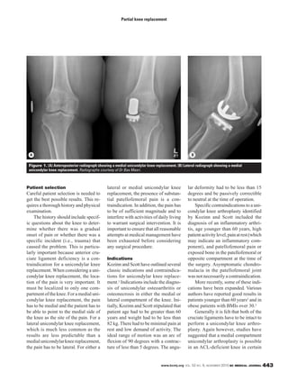 www.bcmj.org VOL. 52 NO. 9, NOVEMBER 2010 BC MEDICAL JOURNAL 443
Patient selection
Careful patient selection is needed to
get the best possible results. This re-
quires a thorough history and physical
examination.
The history should include specif-
ic questions about the knee to deter-
mine whether there was a gradual
onset of pain or whether there was a
specific incident (i.e., trauma) that
caused the problem. This is particu-
larly important because anterior cru-
ciate ligament deficiency is a con-
traindication for a unicondylar knee
replacement. When considering a uni-
condylar knee replacement, the loca-
tion of the pain is very important. It
must be localized to only one com-
partmentoftheknee.Foramedialuni-
condylar knee replacement, the pain
has to be medial and the patient has to
be able to point to the medial side of
the knee as the site of the pain. For a
lateral unicondylar knee replacement,
which is much less common as the
results are less predictable than a
medialunicondylarkneereplacement,
the pain has to be lateral. For either a
lateral or medial unicondylar knee
replacement, the presence of substan-
tial patellofemoral pain is a con-
traindication. In addition, the pain has
to be of sufficient magnitude and to
interfere with activities of daily living
to warrant surgical intervention. It is
important to ensure that all reasonable
attempts at medical management have
been exhausted before considering
any surgical procedure.
Indications
Kozinn and Scott have outlined several
classic indications and contraindica-
tions for unicondylar knee replace-
ment.1 Indications include the diagno-
sis of unicondylar osteoarthritis or
osteonecrosis in either the medial or
lateral compartment of the knee. Ini-
tially, Kozinn and Scott stipulated that
patient age had to be greater than 60
years and weight had to be less than
82 kg. There had to be minimal pain at
rest and low demand of activity. The
ideal range of motion was an arc of
flexion of 90 degrees with a contrac-
ture of less than 5 degrees. The angu-
lar deformity had to be less than 15
degrees and be passively correctible
to neutral at the time of operation.
Specific contraindications to a uni-
condylar knee arthroplasty identified
by Kozinn and Scott included the
diagnosis of an inflammatory arthri-
tis, age younger than 60 years, high
patientactivitylevel,painatrest(which
may indicate an inflammatory com-
ponent), and patellofemoral pain or
exposed bone in the patellofemoral or
opposite compartment at the time of
the surgery. Asymptomatic chondro-
malacia in the patellofemoral joint
was not necessarily a contraindication.
More recently, some of these indi-
cations have been expanded. Various
authors have reported good results in
patients younger than 60 years2 and in
obese patients with BMIs over 30.3
Generally it is felt that both of the
cruciate ligaments have to be intact to
perform a unicondylar knee arthro-
plasty. Again however, studies have
suggested that a medial compartment
unicondylar arthroplasty is possible
in an ACL-deficient knee in certain
Partial knee replacement
Figure 1. (A) Anteroposterior radiograph showing a medial unicondylar knee replacement. (B) Lateral radiograph showing a medial
unicondylar knee replacement. Radiographs courtesy of Dr Bas Masri.
A B
 