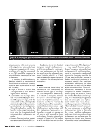 BC MEDICAL JOURNAL VOL. 52 NO. 9, NOVEMBER 2010 www.bcmj.org444
circumstances;4 still, most surgeons
will not perform a unicondylar knee
replacement on a patient with a histo-
ry of torn ACL, and the presence of
a torn ACL should be considered a
contraindicationtoaunicondylarknee
replacement.
In summary, in addition to well-
localized pain with no patellofemoral
involvement, the indications for a uni-
condylar knee replacement include
the following:
• Range of motion of no less than
110 degrees with no more than a 5-
degree flexion deformity.
• Acorrectable varus on valgus defor-
mityofnomorethan5degreesofvar-
us or 15 degrees of valgus, with the
correctability of the deformity to be
determined on physical examination.
• An intact anterior cruciate ligament.
• Osteoarthritis localized to either the
lateralormedialcompartment,keep-
ing in mind that the vast majority of
unicondylar knee replacements are
medial.
• For some fixed-bearing tibial compo-
nentdesigns,aweightlimitof114kg.
Based on the above, it is clear that
not every patient with knee osteo-
arthritis is a candidate for a unicondy-
lar knee replacement, and the final
decision is up to the orthopaedic sur-
geon. Typically, only 10% to 20% of
patients undergoing knee replacement
are candidates for unicondylar knee
arthroplasty.
Results
It is difficult to sort out the results for
unicondylar knee arthroplasty, as
there are different types of unicondy-
lar knee arthroplasties. Additionally,
it is difficult to distinguish between
medial side versus lateral side proce-
dures with respect to outcomes. Fur-
thermore, one has to compare the
results of a unicondylar knee replace-
ment with other options such as a high
tibial osteotomy and a standard total
knee replacement. Again, various au-
thors have reported varying degrees
of success with unicondylar knee
arthroplasty. Recently authors have
reported 96% survival of the implant
at a 10-year follow-up and excellent
or good outcome in 92% of patients.5
Most recently Newman and col-
leagues6 compared unicondylar knee
replacement with total knee replace-
ment in a prospective randomized
control trial. This report stated that the
15-year survivorship for a unicondy-
larkneereplacementwascloseto90%
compared with 80% for a total knee
replacement. Additionally, the report
stated that the unicondylar knee
replacements had more “excellent”
results and a better range of motion
compared with the total knee replace-
ment. Registry data, however, such as
the Swedish Knee Replacement Reg-
istry, have shown a higher reoperation
rate for unicondylar knee replace-
ment, with the main reason for revi-
sion being progression of the arthritis.
The results for revision of a unicondy-
lar knee replacement to a full knee
replacement are similar to the results
for a primary total knee replacement,
and even though unicondylar knee
replacements may not last as long, the
outcome of revision is better than that
of a revision of total knee replacement.
Partial knee replacement
Figure 2: (A) Anteroposterior radiograph showing a patellofemoral replacement. (B) Lateral radiograph showing a patellofemoral replacement.
Radiographs courtesy of Dr Bas Masri.
A B
 