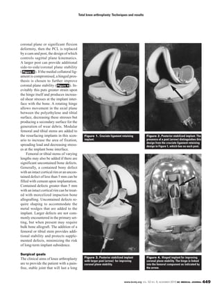 www.bcmj.org VOL. 52 NO. 9, NOVEMBER 2010 BC MEDICAL JOURNAL 449
Total knee arthroplasty: Techniques and results
coronal plane or significant flexion
deformity, then the PCL is replaced
by a cam and post, the design of which
controls sagittal plane kinematics.
A larger post can provide additional
side-to-side/coronal plane stability
( ). If the medial collateral lig-
ament is compromised, a hinged pros-
thesis is chosen to further improve
coronal plane stability ( ). In-
evitably this puts greater strain upon
the hinge itself and produces increas-
ed shear stresses at the implant inter-
face with the bone. A rotating hinge
allows movement in the axial plane
between the polyethylene and tibial
surface, decreasing these stresses but
producing a secondary surface for the
generation of wear debris. Modular
femoral and tibial stems are added to
the resurfacing implants in this scen-
ario to increase the area of fixation,
spreading load and decreasing stress-
es at the implant bone interface.
Femoral or tibial stems of varying
lengths may also be added if there are
significant uncontained bone defects.
Generally, a contained bony defect
with an intact cortical rim or an uncon-
tained defect of less than 5 mm can be
filled with cement upon implantation.
Contained defects greater than 5 mm
with an intact cortical rim can be treat-
ed with morcelized impaction bone
allografting. Uncontained defects re-
quire shaping to accommodate the
metal wedges that are added to the
implant. Larger defects are not com-
monly encountered in the primary set-
ting, but when present may require
bulk bone allograft. The addition of a
femoral or tibial stem provides addi-
tional stability and protects supple-
mented defects, minimizing the risk
of long-term implant subsidence.
Surgical goals
The clinical aims of knee arthroplasty
are to provide the patient with a pain-
free, stable joint that will last a long
Figure 4
Figure 3
Figure 1. Cruciate ligament retaining
implant.
Figure 2. Posterior stabilized implant. The
presence of a post (arrow) distinguishes this
design from the cruciate ligament retaining
design in Figure 1, which has no such post.
Figure 3. Posterior stabilized implant
with larger post (arrow) for improving
coronal plane stability.
Figure 4. Hinged implant for improving
coronal plane stability. The hinge is linked
into the femoral component as indicated by
the arrow.
 