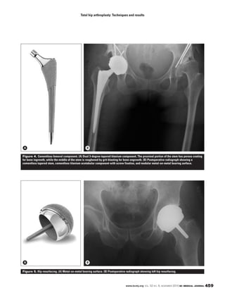 www.bcmj.org VOL. 52 NO. 9, NOVEMBER 2010 BC MEDICAL JOURNAL 459
Total hip arthroplasty: Techniques and results
Figure 4. Cementless femoral component. (A) Dual 3-degree tapered titanium component. The proximal portion of the stem has porous coating
for bone ingrowth, while the middle of the stem is roughened by grit-blasting for bone ongrowth. (B) Postoperative radiograph showing a
cementless tapered stem, cementless titanium acetabular component with screw fixation, and modular metal-on-metal bearing surface.
Figure 5. Hip resurfacing. (A) Metal-on-metal bearing surface. (B) Postoperative radiograph showing left hip resurfacing.
A B
A B
 