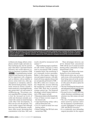BC MEDICAL JOURNAL VOL. 52 NO. 9, NOVEMBER 2010 www.bcmj.org460
(withoutcysticchange,defects,ordys-
plasia), normal weight, and male sex.
Hip resurfacing may also be used ad-
junct when there is proximal femoral
deformity that would otherwise re-
quire an osteotomy to perform a THR
( ). Contraindications include
impaired renal function (or the poten-
tial for impairment with a diagnosis
such as diabetes) with an inability to
process serum metal ions, older age,
osteoporosis or osteopenia, unfavor-
able femoral head geometry, clinical
metal sensitivity history (usually a
nickelsensitivity),aleg-lengthdiscrep-
ancy greater than 1 cm, and women of
childbearing age. The primary con-
cern regarding HR in younger women
is how the increased ion levels of
cobalt and chromium normally asso-
ciated with a metal-on-metal bearings
could effect fetal development, as
these ions do cross the placenta. Two
recent studies suggest that although
these ions cross the placenta, a modu-
latory effect occurs, decreasing their
concentration in the fetus. Still, such
Figure 6
results should be interpreted with
caution.22,23
Hipresurfacingsurgeryisperform-
ed with similar exposures to those
used in conventional THR. Contrary
to popular belief, hip resurfacing is
not a minimally invasive procedure.
Rather, it often requires a larger inci-
sion and surgical exposure, with addi-
tional soft tissue capsular releases that
are not typically performed in THR—
thus HR is often more invasive, not
less. Despite this, recovery following
hip resurfacing is similar to conven-
tional THR, likely due to generally
younger patient age. The proposed
advantages (which remain controver-
sial) of HR surgery include:
• Bonepreservationonthefemoralside.
• Ease of future revision surgery on
the femoral side.
• Large-head bearing surface with a
reduced dislocation rate.
• Use of a metal-on-metal low-wear
bearing surface.
• Patient findings that HR feels more
normal than THR.
These advantages, however, can
all be obtained from conventional
THR with the use of a metal-on-metal
bearing surface, particularly if a large
femoral head is used.
Surgeons who disfavor hip resur-
facing do so for several reasons:
• Bone preservation may not neces-
sarily occur, with occasionally more
bone being removed on the acetab-
ularsidetoachieveadeepenedsock-
et with a press-fit and no option for
screw fixation.
• Theriskofnotchingthefemoralneck
and subsequent femoral neck fracture
(risk 0.8%–1.5%)24,25 ( ).
• Elevated levels of serum and urine
cobalt, chromium, molybdenum, and
selenium ions that remain elevated
lifelong.
• The risk of lymphocyte-mediated
metal sensitivity reactions and/or
the development of pseudotumors,
recently highlighted in research at
UBC and McGill University.26
• It is a technically more demanding
surgical procedure for the surgeon
Figure 7
Total hip arthroplasty: Techniques and results
Figure 6. Hip resurfacing in case of proximal femoral deformity. (A) Preoperative radiograph used to investigate left hip pain. This patient had
previously undergone an intertrochanteric osteotomy. The residual femoral canal deformity seen on the radiograph means that an osteotomy
would be required to perform a THR with a femoral component stem. (B) Postoperative radiograph showing left hip resurfacing performed to
avoid the femoral osteotomy.
A B
 