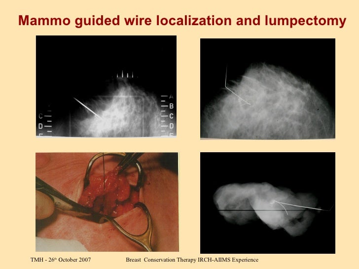 BCT AIIMS Experience