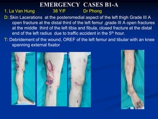 1. La Van Hung 38 Y/F Dr Phong
D: Skin Lacerations at the posteromedial aspect of the left thigh Grade III A
open fracture at the distal third of the left femur ,grade III A open fractures
at the middle third of the left tibia and fibula, closed fracture at the distal
end of the left radius due to traffic accident in the 5th hour.
T: Debridement of the wound, OREF of the left femur and tibular with an knee
spanning external fixator
EMERGENCY CASES B1-A
 