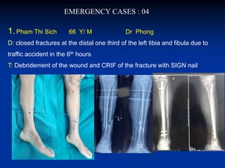 EMERGENCY CASES : 04
1.Pham Thi Sich 66 Y/ M Dr Phong
D: closed fractures at the distal one third of the left tibia and fibula due to
traffic accident in the 6th hours
T: Debridement of the wound and CRIF of the fracture with SIGN nail
 