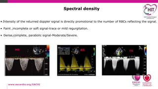 Basic concepts of valvular regurgitation-Echocardiography | PPTX