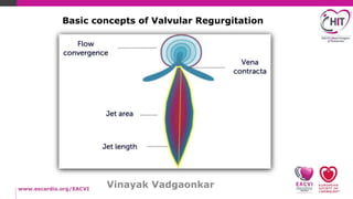 Vinayak Vadgaonkar
Basic concepts of Valvular Regurgitation
 