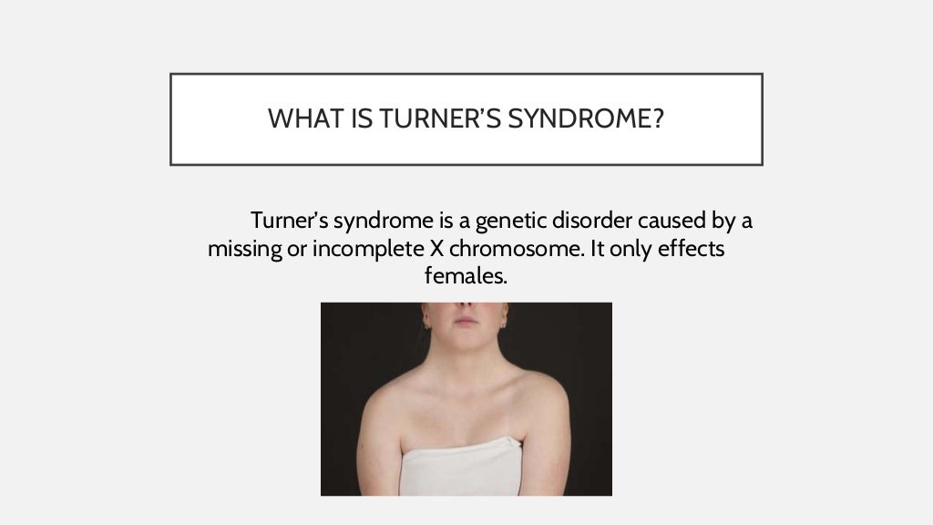 Turner syndrome