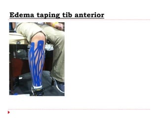 Edema taping tib anterior
 