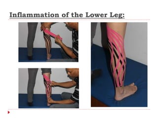 Inflammation of the Lower Leg:
 
