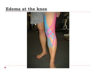 Edema at the knee
 