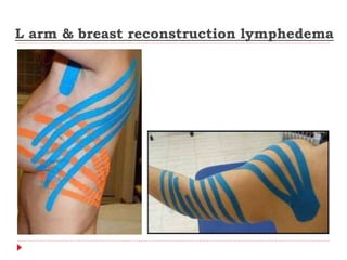 L arm & breast reconstruction lymphedema
 