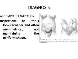 DIAGNOSIS
ABDOMINAL EXAMINATION
Inspection: The uterus
looks broader and often
asymmetrical, not
maintaining the
pyriform shape.
 