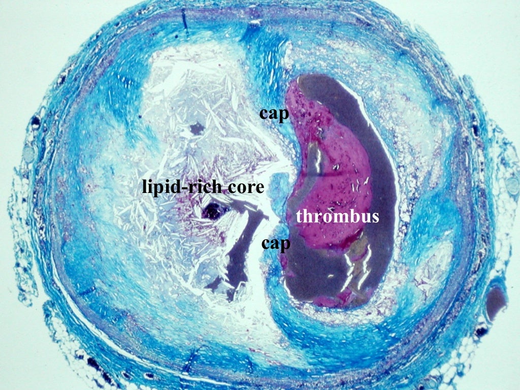 Plaque rupture definition