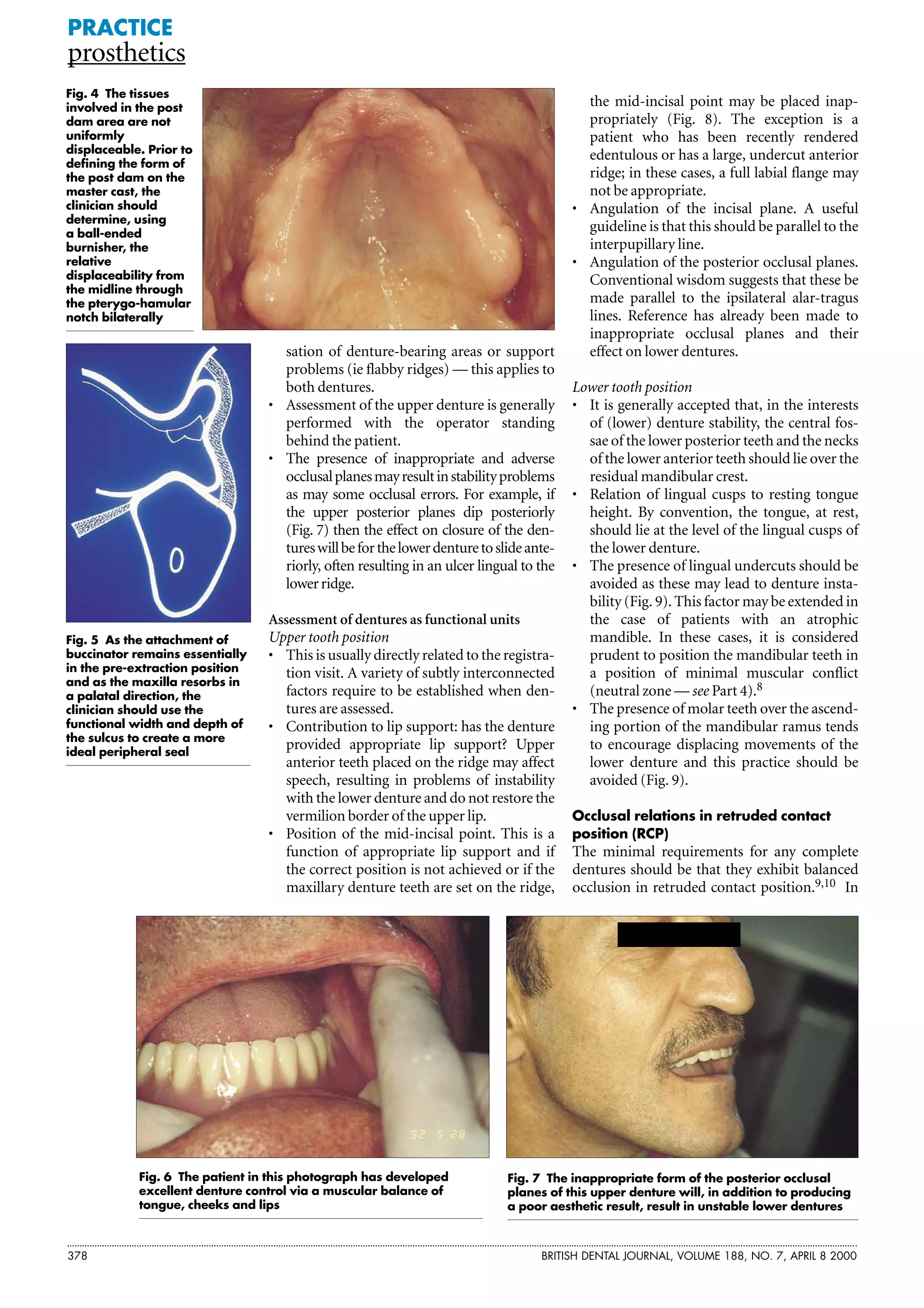 Bdj complete denture | PDF